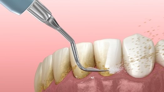 Illustrated dental instrument cleaning plaque buildup off of teeth