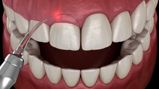 Illustration of laser gummy smile correction