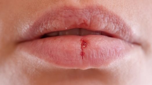 Close up of mouth with dry cracked lips