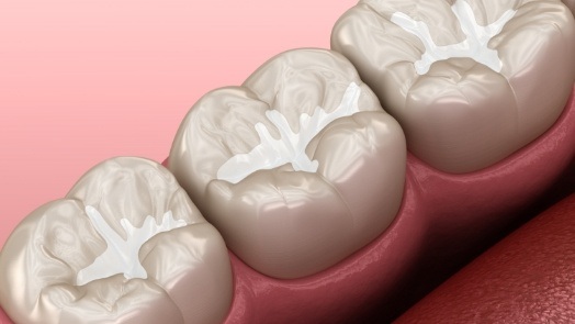 Illustrated row of teeth with tooth colored fillings