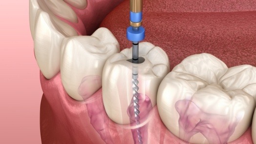 Illustrated dental instrument cleaning inside of tooth during root canal treatment in Tulsa