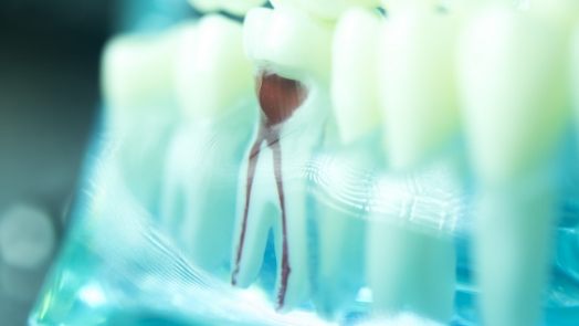 Model of tooth showing root canal pathways inside of it