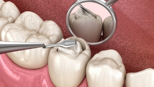 Illustrated close up of tooth colored filling being placed inside of a tooth