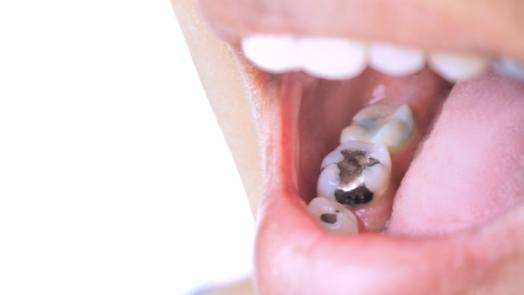 Close up of person smiling with several gray fillings