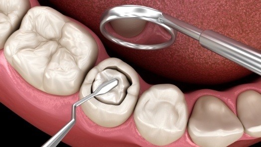 Illustration of tooth colored filling process