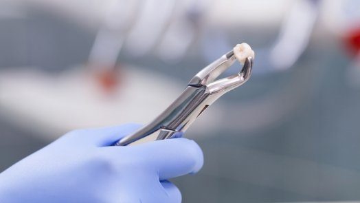 Dental forceps holding a tooth after tooth extraction in Tulsa