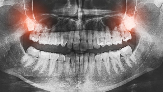 Dental X ray with impacted wisdom teeth highlighted red