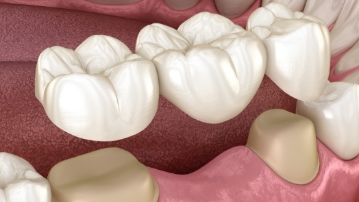 Illustrated dental bridge being fitted to replace a missing tooth