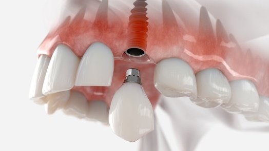 Illustration of dental crown being placed on dental implant in upper jaw