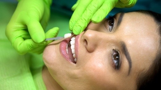 Cosmetic dentist placing a veneer over the front tooth of a patient