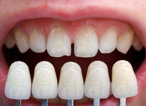 porcelain veneers