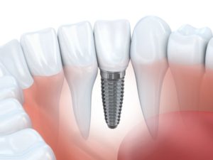 Dental Implant With Real Teeth