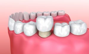 diagram of dental crown