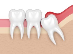Impacted wisdom tooth