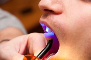 a patient receiving dental bonding