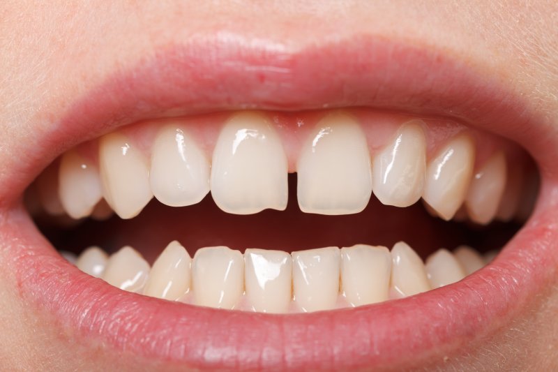 Close-up of a smile with a gap between front teeth