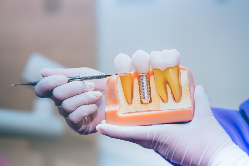 Dentist showing off a dental implant