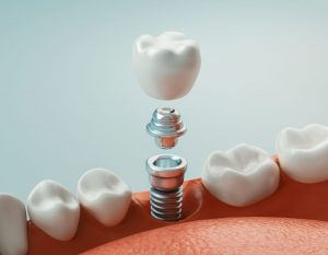 CGI illustration of a dental implant crown and rod in front of a gray background