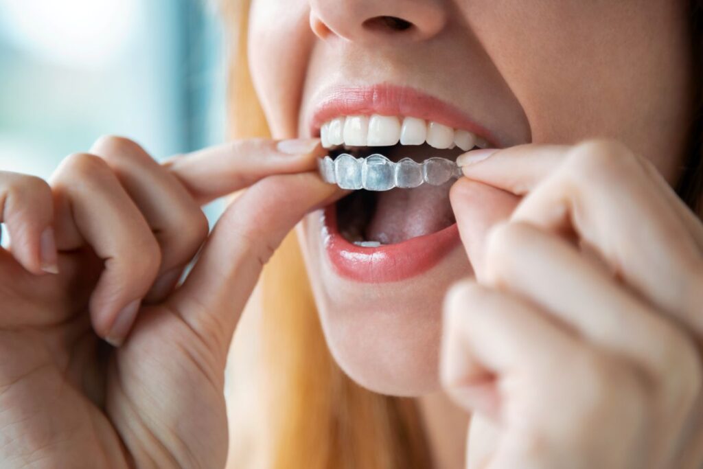A woman putting on Invisalign aligners.