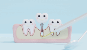 Graphic of a dental implant being anchored to the jawbone