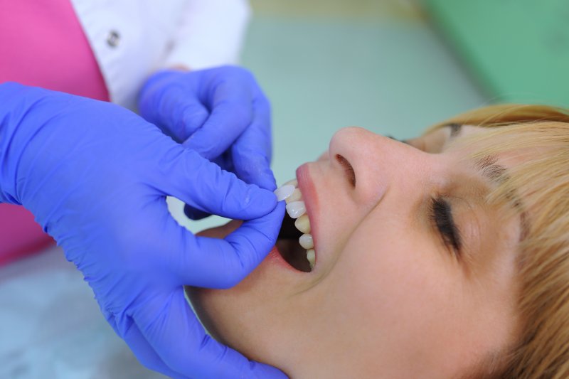 A dentist carefully placing veneers on a woman’s teeth